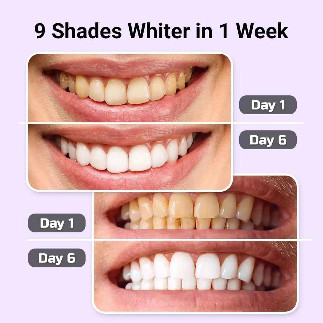 کیت سفید کننده دندان – نور LED و ژل سفید کننده به همراه سرنگ های معدنی کننده – سفید کننده حرفه ای برای دندان های حساس – از بین برنده لکه های ناشی از قهوه، شراب و سیگار کیت سفید کننده دندان – نور LED و ژل سفید کننده به همراه سرنگ های معدنی کننده – سفید کننده حرفه ای برای دندان های حساس – از بین برنده لکه های ناشی از قهوه، شراب و سیگار