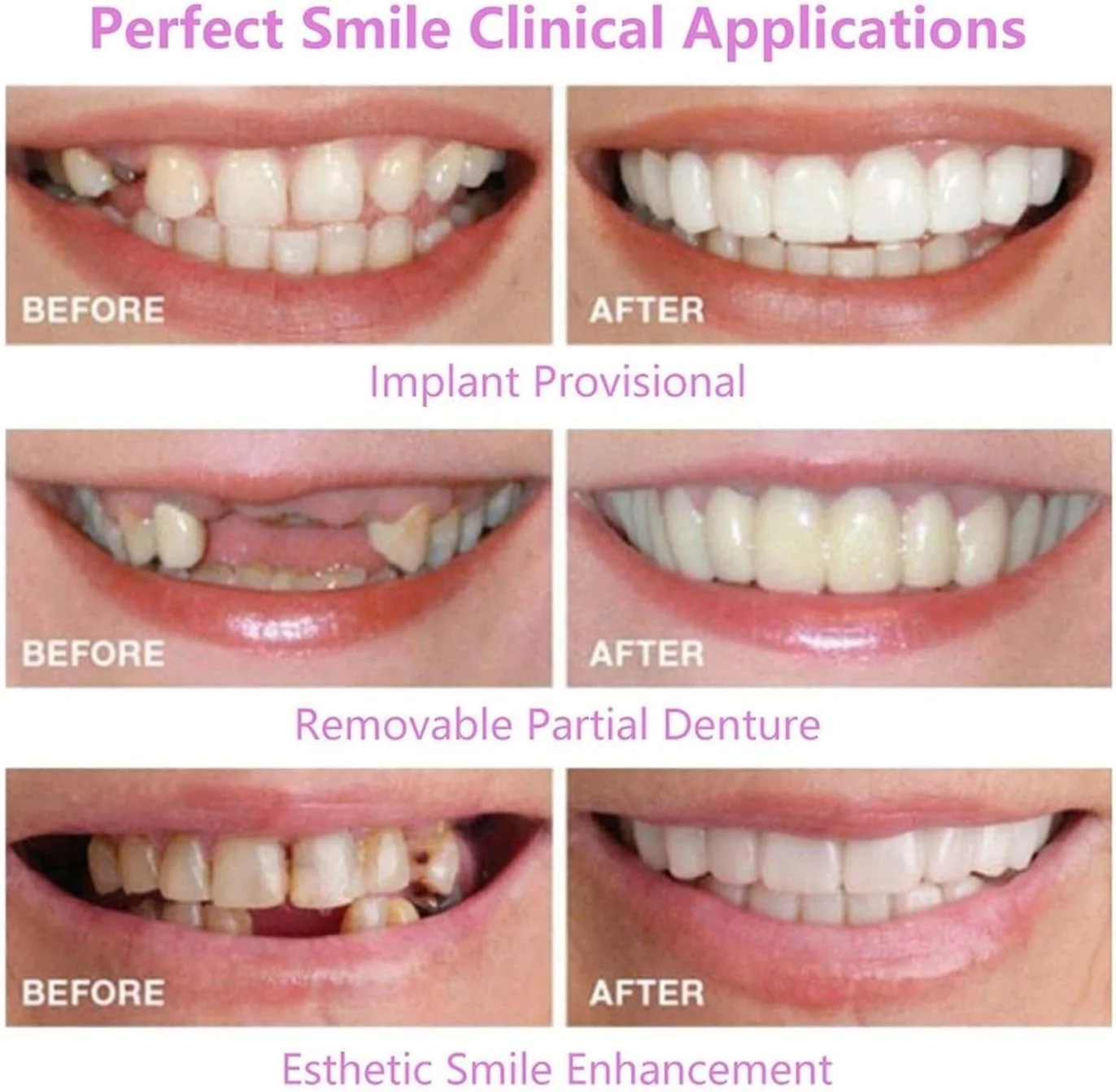 ۲ جفت، موقت، طبیعی و راحت، قابل تنظیم برای آقایان و بانوان، لبخند زیبا (۱) ۲ جفت، موقت، طبیعی و راحت، قابل تنظیم برای آقایان و بانوان، لبخند زیبا (۱)