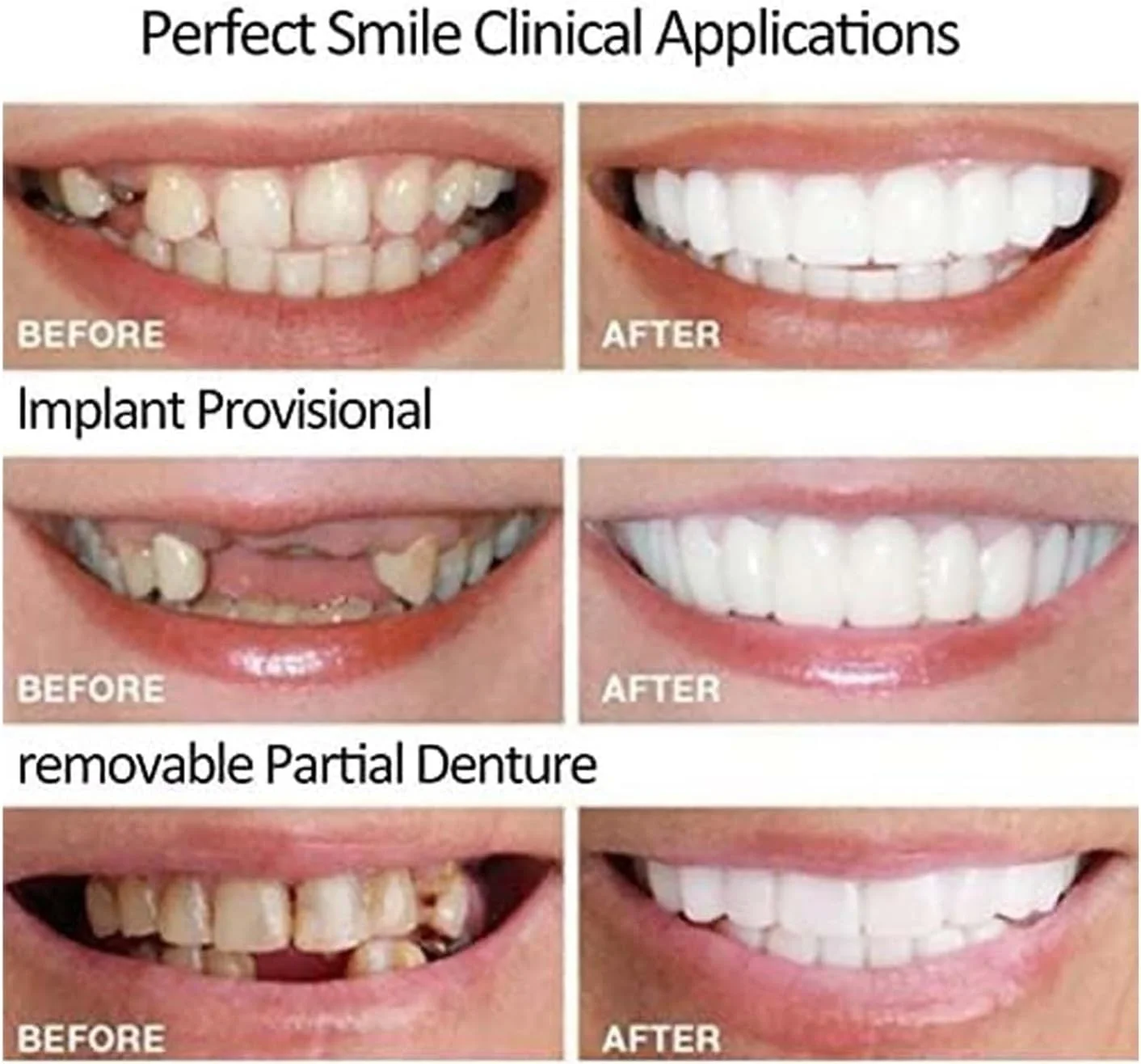 2 جفت، دندان های مصنوعی موقت طبیعی و راحت برای بازیابی لبخند مطمئن، مناسب برای آقایان و خانم ها (1) 2 جفت، دندان های مصنوعی موقت طبیعی و راحت برای بازیابی لبخند مطمئن، مناسب برای آقایان و خانم ها (1)