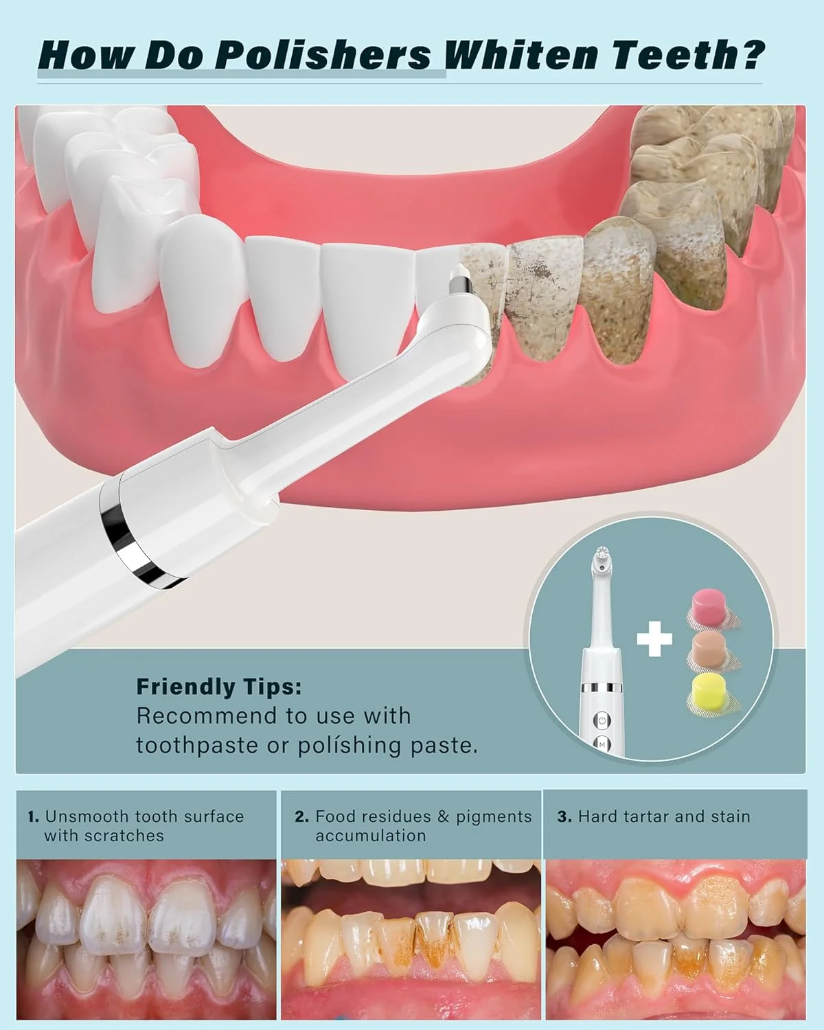 مجموعه سفید کننده دندان، مجموعه سفید کننده دندان Stim-U-Dent برای تمیز کردن و سفید کردن دندان (AWhite)
