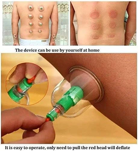 مجموعه درمان حجامت خلاء - 12 عدد فنجان، ماساژور کل بدن