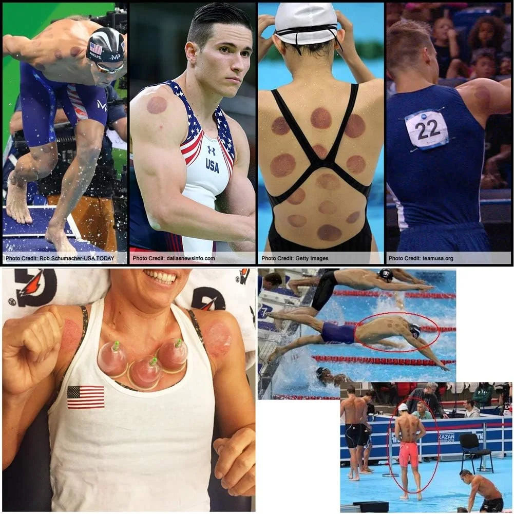 مجموعه حجامت موچو، مجموعه های حرفه ای طب سوزنی چینی، مجموعه حجامت مکشی با پمپ مغناطیسی وکیوم، کیت ماساژ حجامت سلولیت 22 تکه