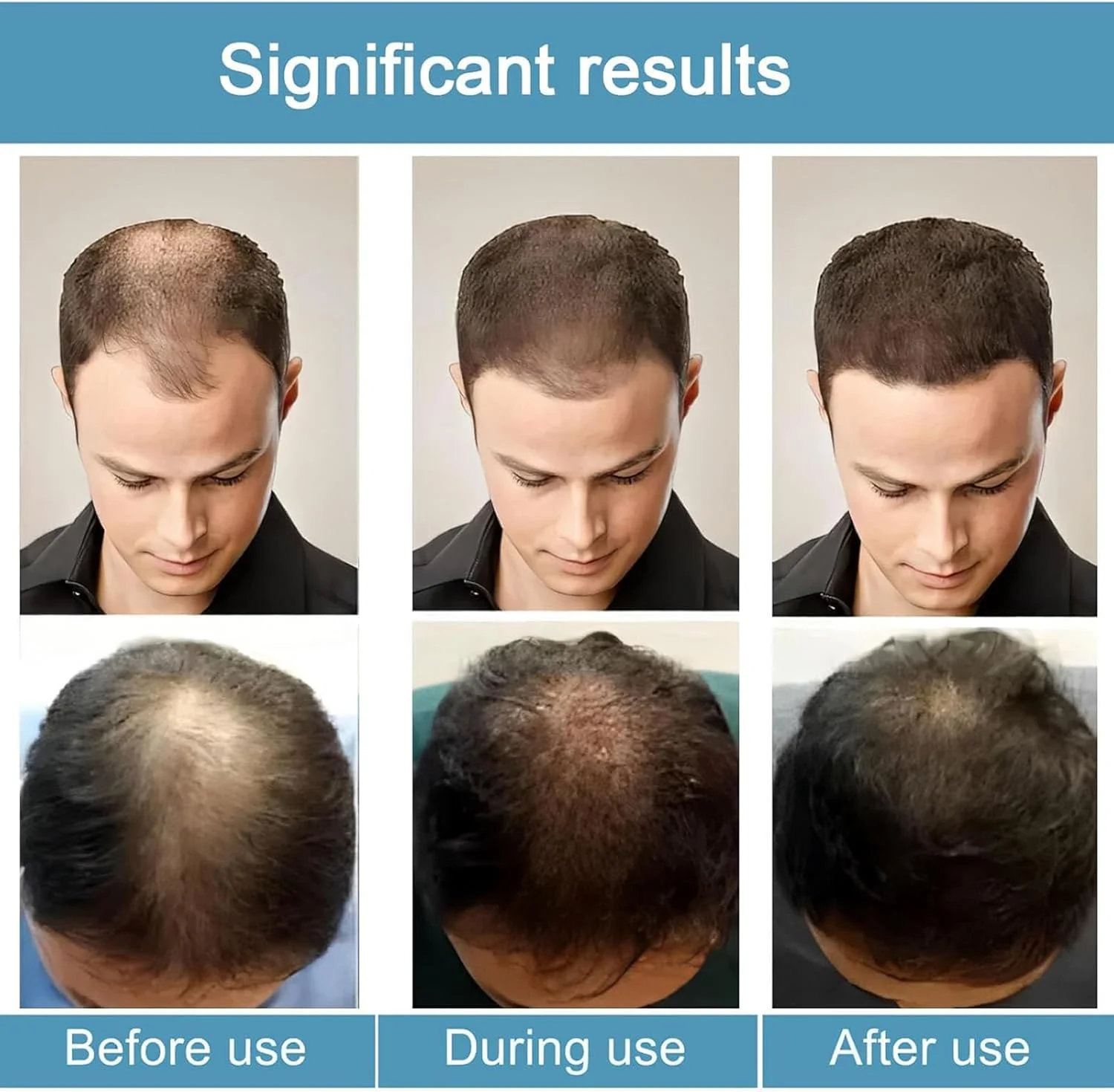 مجموعه پیشرفته تقویت مو آلفا اینفیوز، سرم درمان رشد مو برای موهای ضخیم تر و پرپشت تر، تقویت کننده ریشه، ملایم و بدون درد، پشتیبانی از رشد موهای سالم برای آقایان و بانوان (3 عدد) مجموعه پیشرفته تقویت مو آلفا اینفیوز، سرم درمان رشد مو برای موهای ضخیم تر و پرپشت تر، تقویت کننده ریشه، ملایم و بدون درد، پشتیبانی از رشد موهای سالم برای آقایان و بانوان (3 عدد)