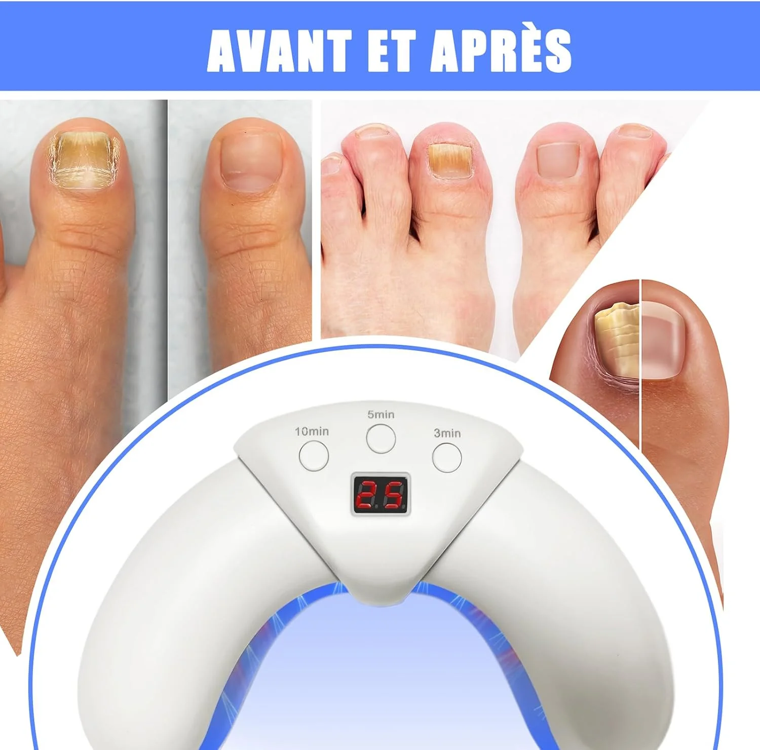 دستگاه لیزر قارچ ناخن برای چندین ناخن پا و ناخن های آسیب دیده و تغییر رنگ یافته با صفحه نمایش دیجیتال و عملکرد تایمر (سفید) دستگاه لیزر قارچ ناخن برای چندین ناخن پا و ناخن های آسیب دیده و تغییر رنگ یافته با صفحه نمایش دیجیتال و عملکرد تایمر (سفید)