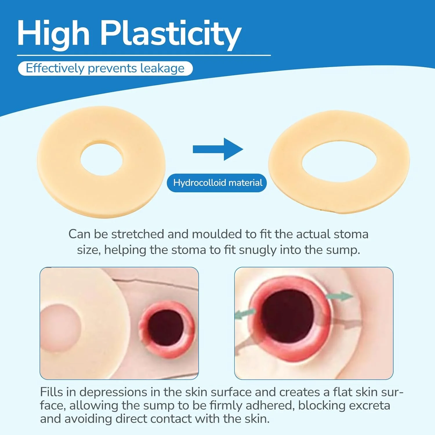 حلقه های محافظ استومی 10 عددی، لوازم استومی، حلقه های استومی قالب پذیر با ضخامت 2 میلی متر، حلقه های محافظ چسب هیدروکلوئیدی درجه پزشکی، مهر و موم بهتر برای کیسه های استومی (جعبه 10 عددی)