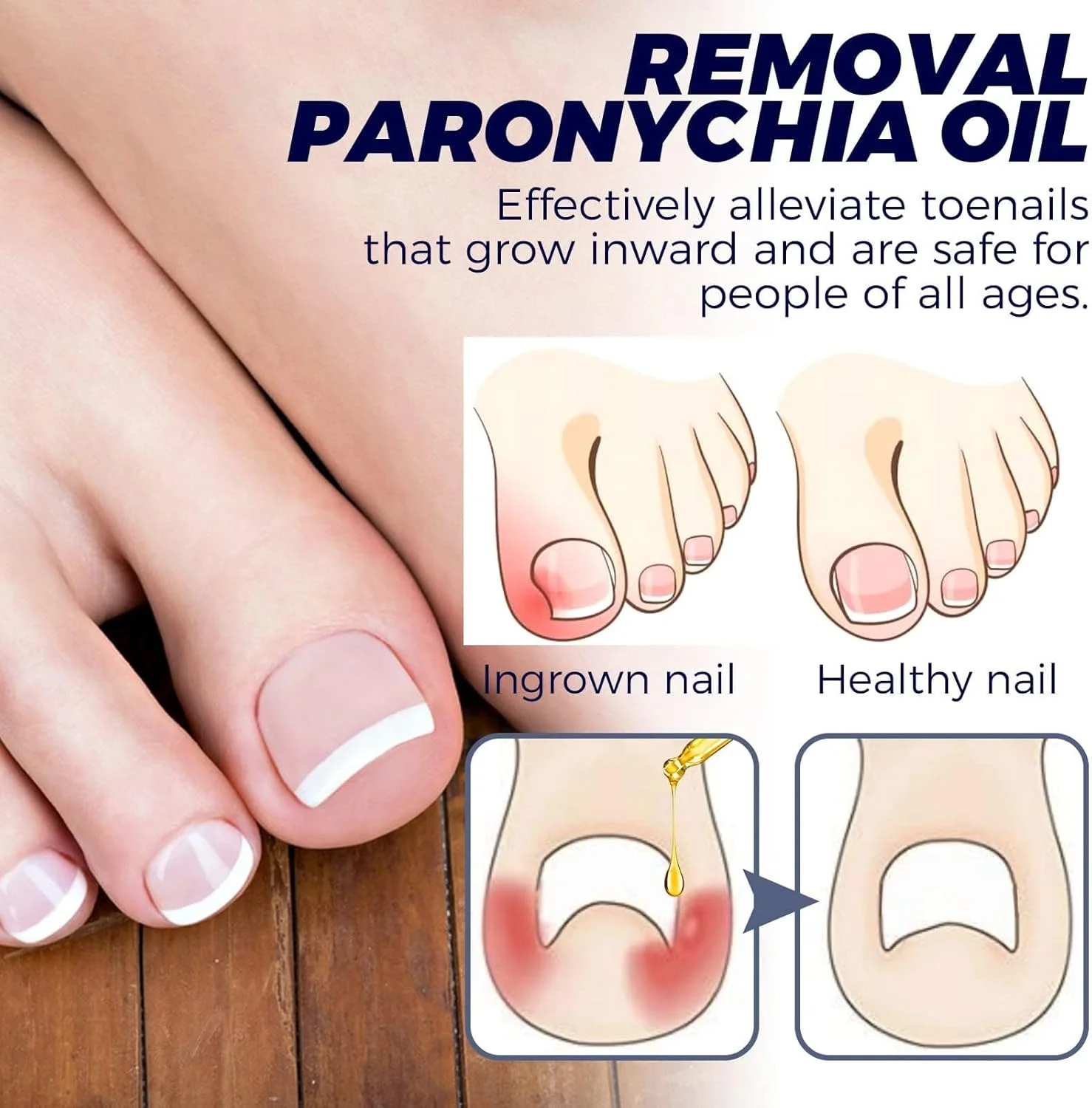 روغن مراقبت از ناخن پا، محلول تسکین دهنده و ترمیم کننده ناخن، نرم کننده ناخن های فرورفته، درمان ناخن پا و قارچ پا، درمان ضد عفونت ناخن، 2 عدد برای ناخن های سالم تر