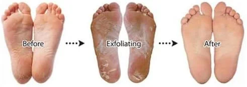 ماسک لایه بردار پا Purederm