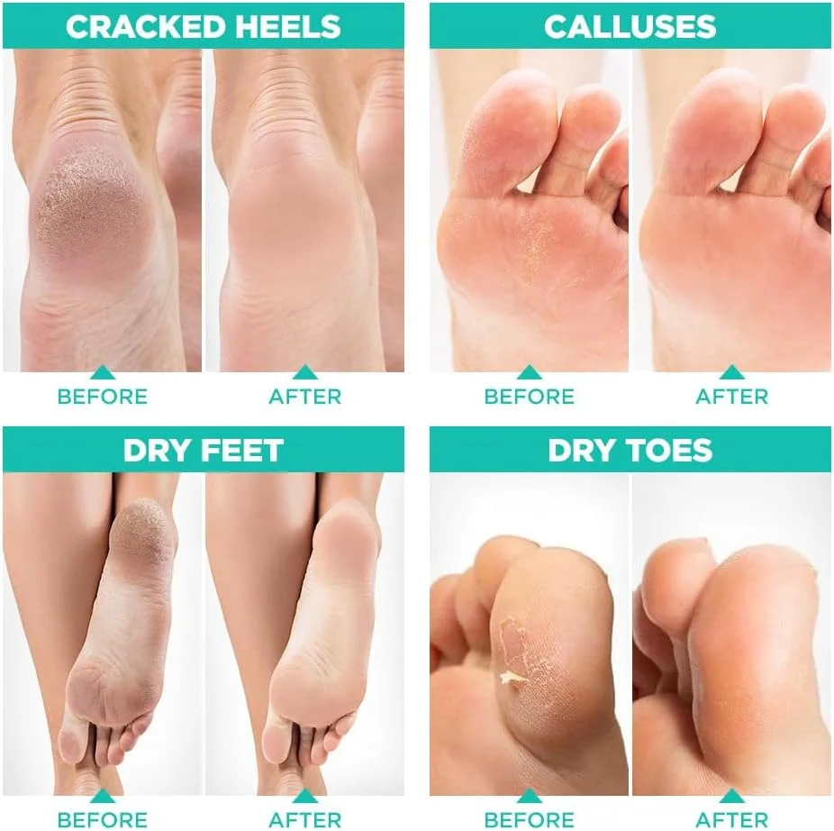 ماسک لایه بردار پا 2 عددی، از بین برنده پینه و سلول های مرده پوست، نرم کننده پاهای شما، ماسک لایه بردار پا، ترمیم کننده پاشنه های زبر، داشتن پاهایی نرم و ابریشمی توسط Lavinso ماسک لایه بردار پا 2 عددی، از بین برنده پینه و سلول های مرده پوست، نرم کننده پاهای شما، ماسک لایه بردار پا، ترمیم کننده پاشنه های زبر، داشتن پاهایی نرم و ابریشمی توسط Lavinso