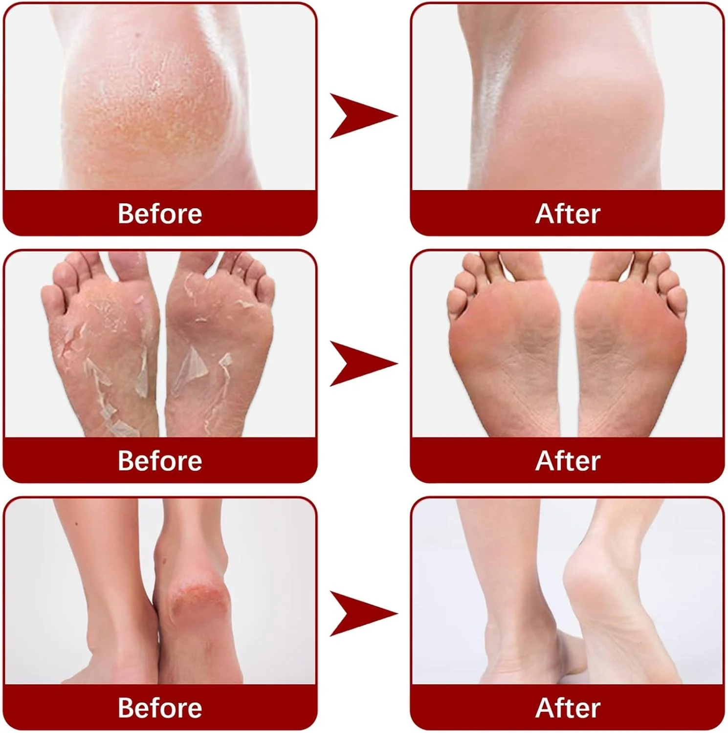 ماسک لایه بردار پا، ماسک مراقبت از پا، 10 جفت ماسک پا لایه بردار طبیعی برای پوست های خشک و مرده، ترمیم پینه های زبر برای آقایان و بانوان (اسید میوه) ماسک لایه بردار پا، ماسک مراقبت از پا، 10 جفت ماسک پا لایه بردار طبیعی برای پوست های خشک و مرده، ترمیم پینه های زبر برای آقایان و بانوان (اسید میوه)