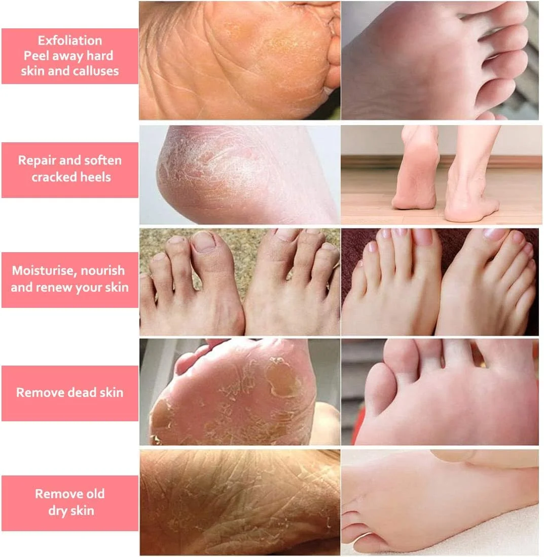 ماسک پا NIFEISHI EU، 3 جفت ماسک لایه بردار پا برای پوست سخت، جوراب های لایه بردار پا برای پینه - پدیکور از بین برنده پوست سخت، جوراب های لایه بردار پا برای مردان و زنان ماسک پا NIFEISHI EU، 3 جفت ماسک لایه بردار پا برای پوست سخت، جوراب های لایه بردار پا برای پینه - پدیکور از بین برنده پوست سخت، جوراب های لایه بردار پا برای مردان و زنان