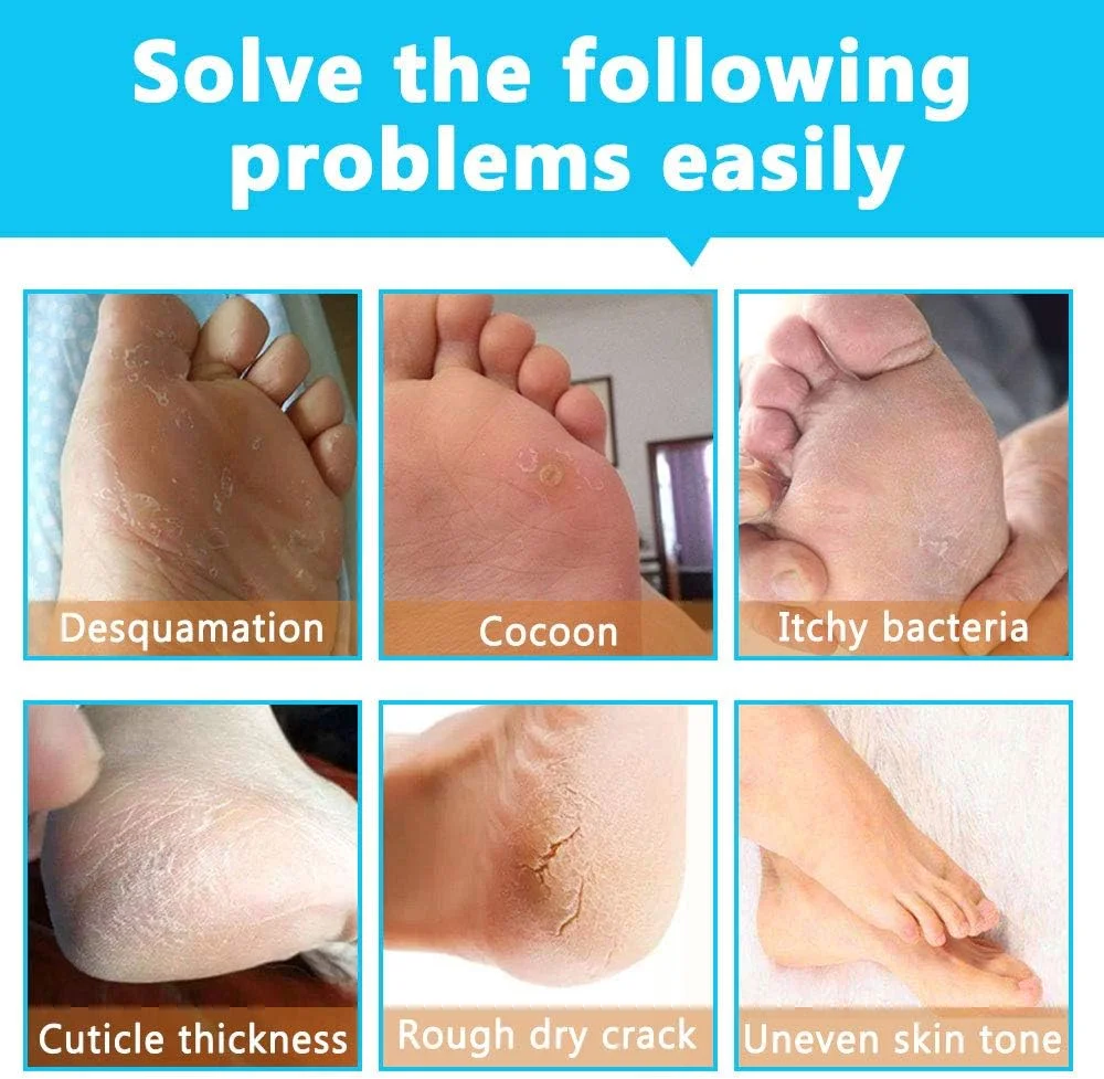 ماسک لایه بردار پا NIFEISHI، 5 جفت، پد لایه بردار پینه پا، لایه برداری پینه و پوست مرده، پاهای نرم و لطیف کودکانه - مردانه و زنانه ماسک لایه بردار پا NIFEISHI، 5 جفت، پد لایه بردار پینه پا، لایه برداری پینه و پوست مرده، پاهای نرم و لطیف کودکانه - مردانه و زنانه
