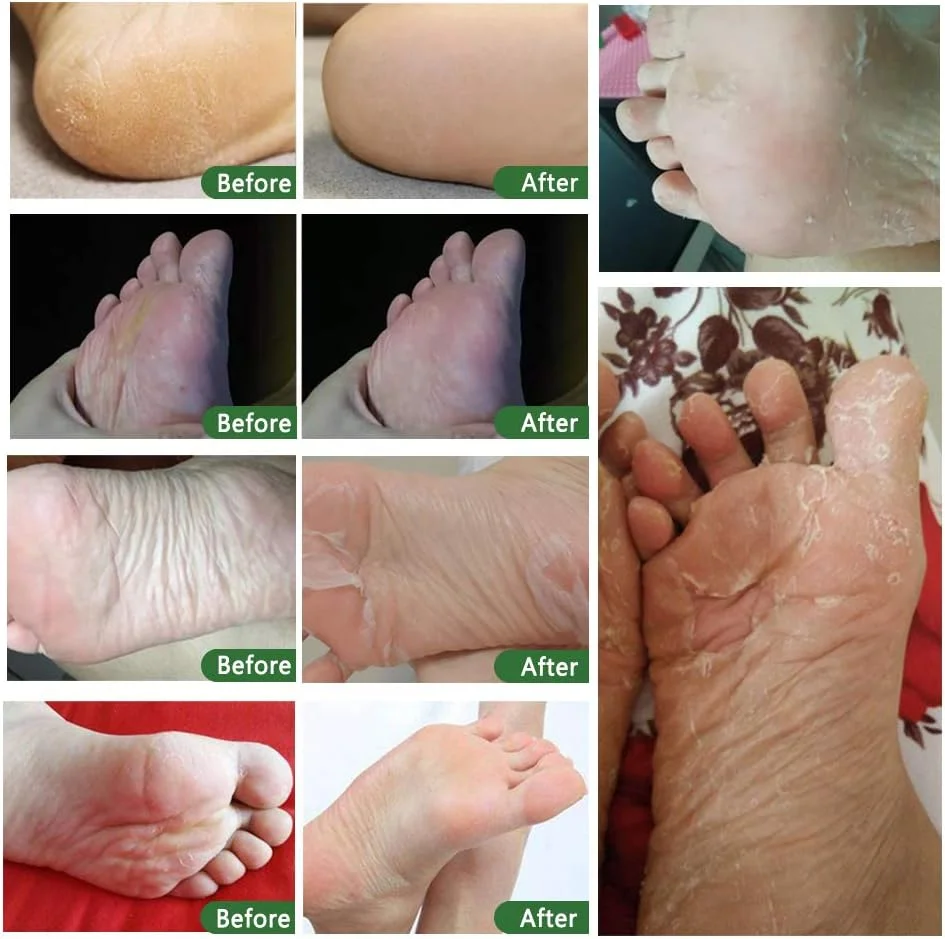 ماسک لایه بردار پا ALIVER - بسته 5 عددی، ماسک لایه بردار پا برای داشتن پوستی نرم مانند پوست کودک، ترمیم پوست مرده، پینه و ترک پا - اسطوخودوس