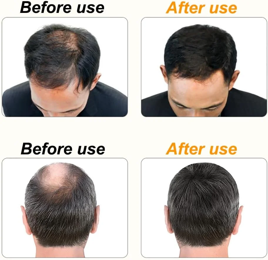 کلاه رشد مو با نور قرمز آسیا، دستگاه مراقبت از فولیکول مو با LED مادون قرمز، ضد ریزش مو و ضخیم کننده، تجهیزات بازیابی پوست سر برای مردان و زنان