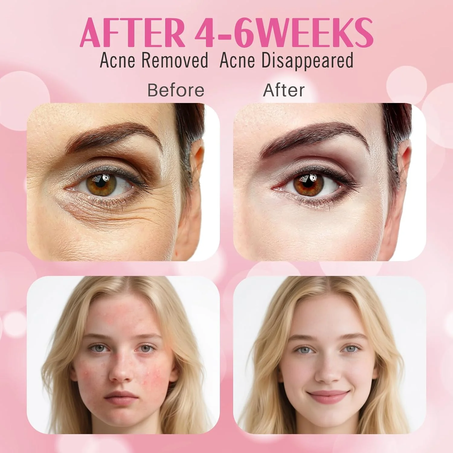 دستگاه درمان آکنه صورت با نور LED