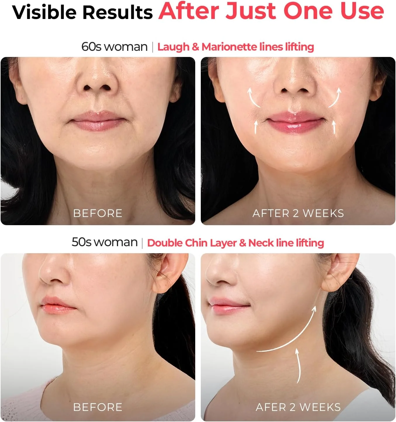 دستگاه آر اف و ال ای دی خانگی Aalok Ultra Olla برای لیفتینگ و جوانسازی پوست