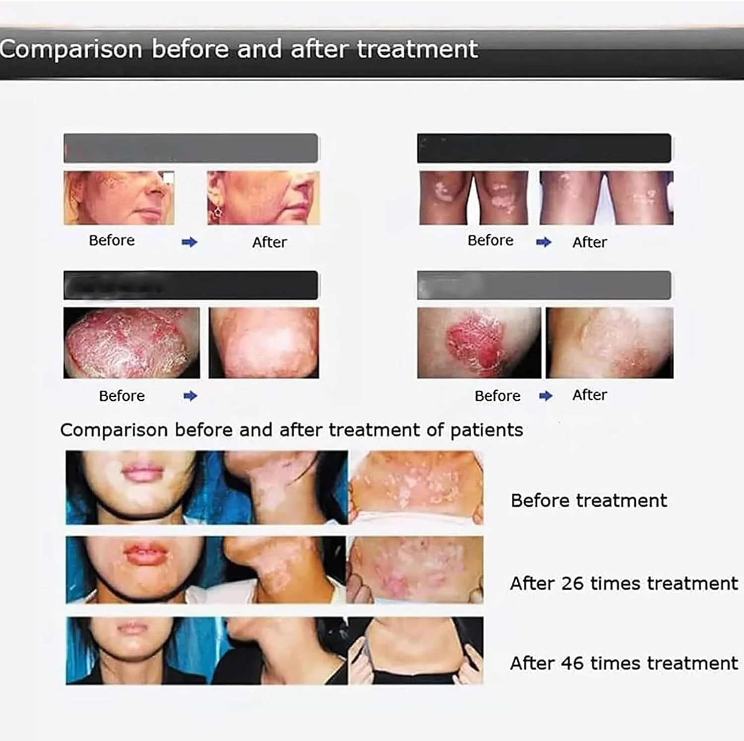 دستگاه مراقبت از پوست طیف باریک 311، لامپ فتوتراپی UVB قابل حمل، به همراه عینک محافظ، محدوده تابش: 48 سانتی متر مربع، برای پوست، بدن، پوست سر، الف