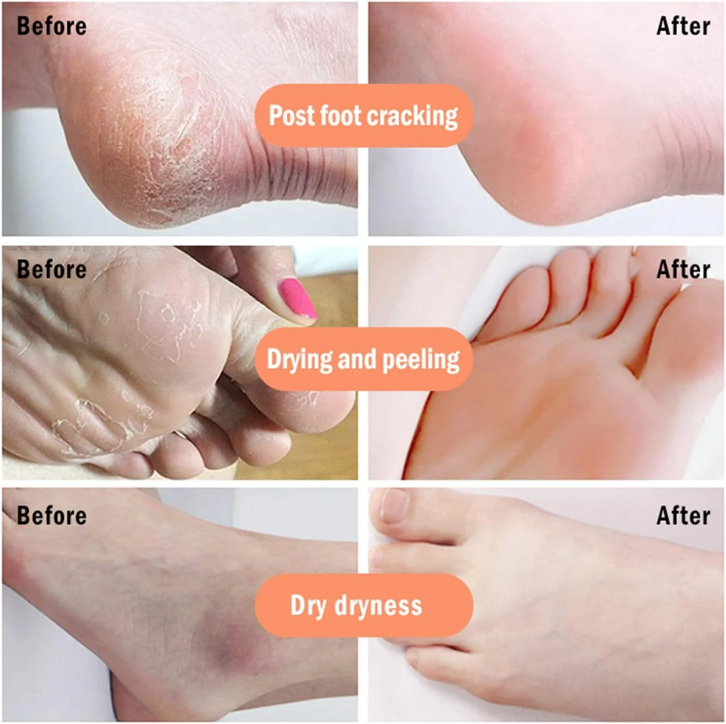 کرم ترمیم کننده دست و پا، کرم ترمیم کننده پوست ترک خورده، کرم مرطوب کننده و آبرسان ترمیم ترک پاشنه پا، ماسک پا خشک، کرم ترمیم کننده ترک پاشنه پا خشک