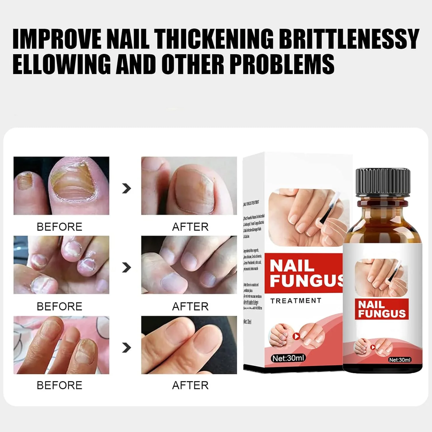 محلول درمان قارچ ناخن پا، درمان ضد قارچی ناخن پا، کیت ترمیم ناخن، محلول قارچ ناخن، ایمن و موثر 30 میلی لیتر محلول درمان قارچ ناخن پا، درمان ضد قارچی ناخن پا، کیت ترمیم ناخن، محلول قارچ ناخن، ایمن و موثر 30 میلی لیتر