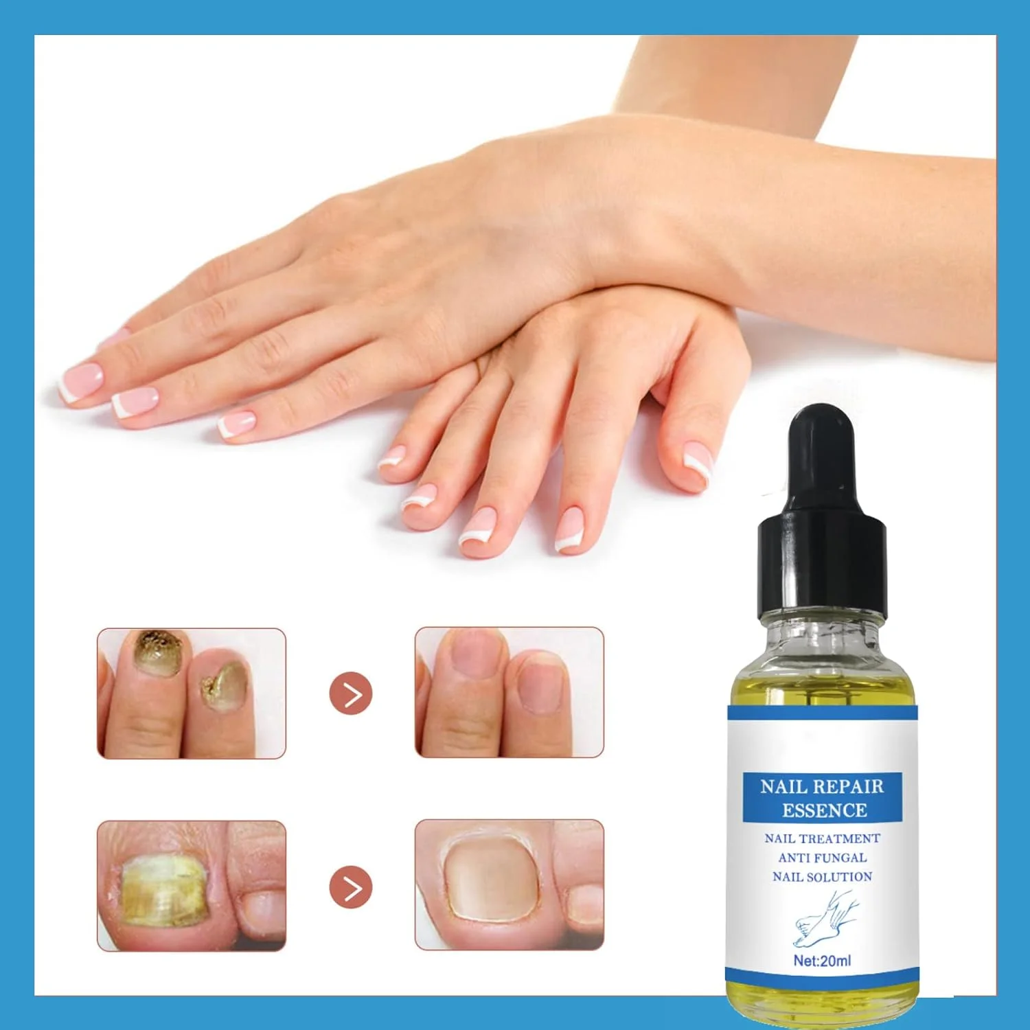 محلول درمان قارچ ناخن پا، درمان قارچ ناخن، ضد قارچ ناخن پا، ترمیم ناخن محلول درمان قارچ ناخن پا، درمان قارچ ناخن، ضد قارچ ناخن پا، ترمیم ناخن