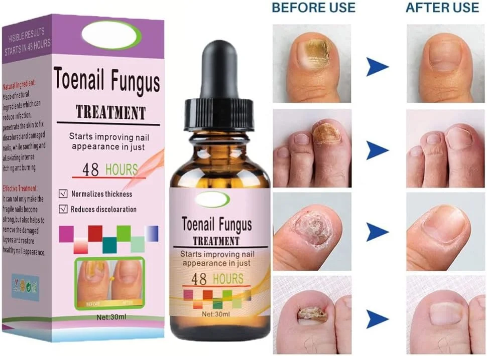 محلول طبیعی درمان قارچ ناخن پا، درمان قارچ ناخن، محلول قوی ضد قارچ ناخن پا، ترمیم ناخن، اسانس درمان ناخن محلول طبیعی درمان قارچ ناخن پا، درمان قارچ ناخن، محلول قوی ضد قارچ ناخن پا، ترمیم ناخن، اسانس درمان ناخن