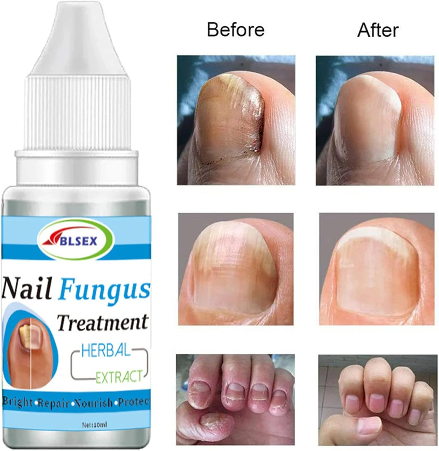 محلول درمان قارچ ناخن پا، محلول قوی ضد قارچ ناخن، تقویت کننده و روغن مراقبت از ناخن برای ناخن های پا و انگشتان دست، درمان اصلاح ناخن فرورفته محلول درمان قارچ ناخن پا، محلول قوی ضد قارچ ناخن، تقویت کننده و روغن مراقبت از ناخن برای ناخن های پا و انگشتان دست، درمان اصلاح ناخن فرورفته