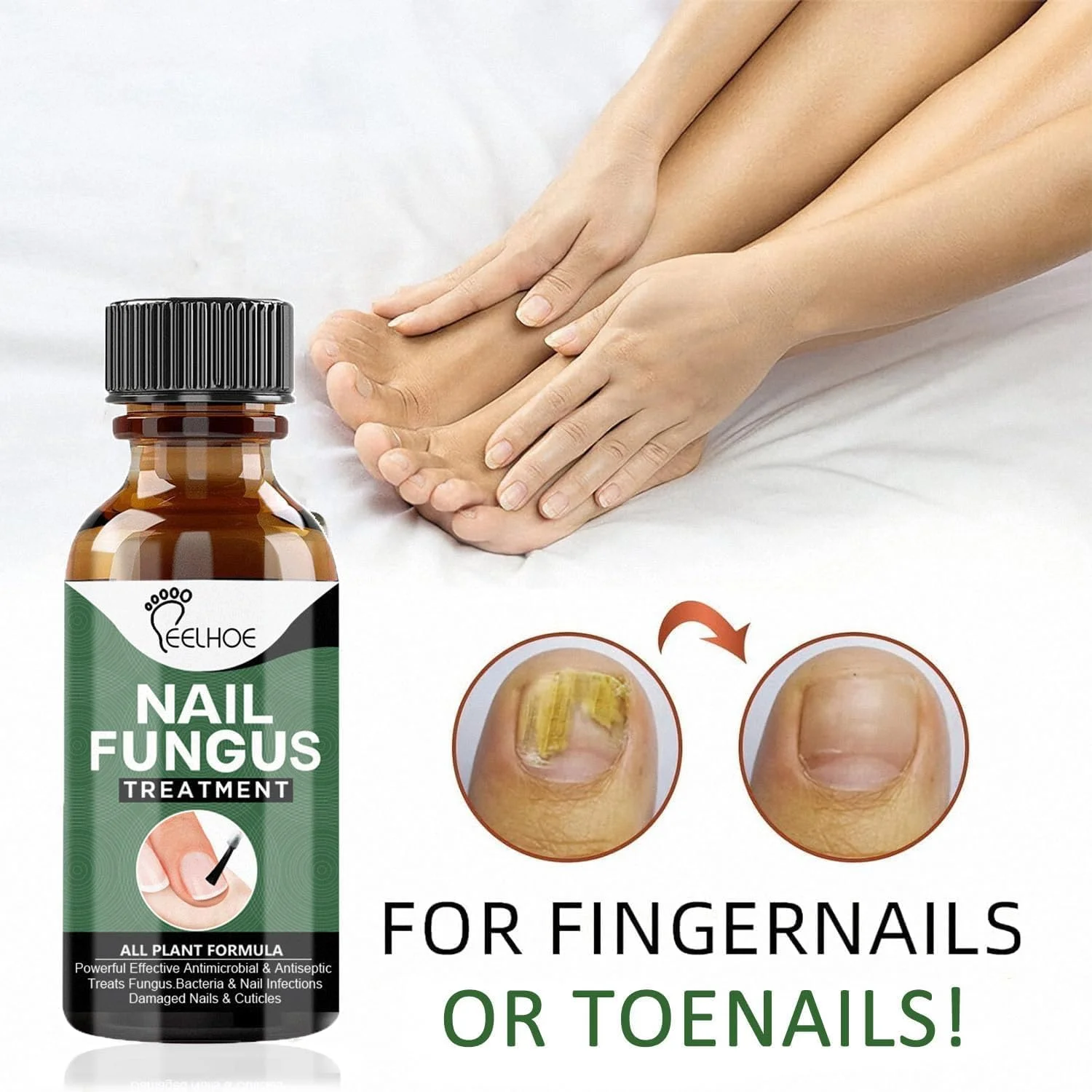 روغن درمان قارچ ناخن FUIN، ترمیم کننده ضد قارچ برای ناخن های آسیب دیده و تغییر رنگ یافته، محلول احیای ناخن سالم، 30 میلی لیتر