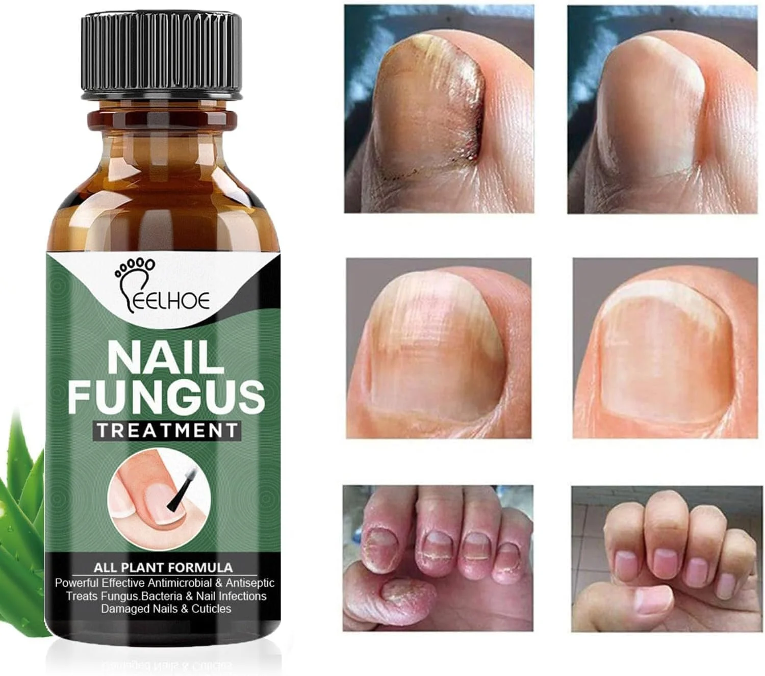 روغن درمان قارچ ناخن FUIN، ترمیم کننده ضد قارچ برای ناخن های آسیب دیده و تغییر رنگ یافته، محلول احیای ناخن سالم، 30 میلی لیتر