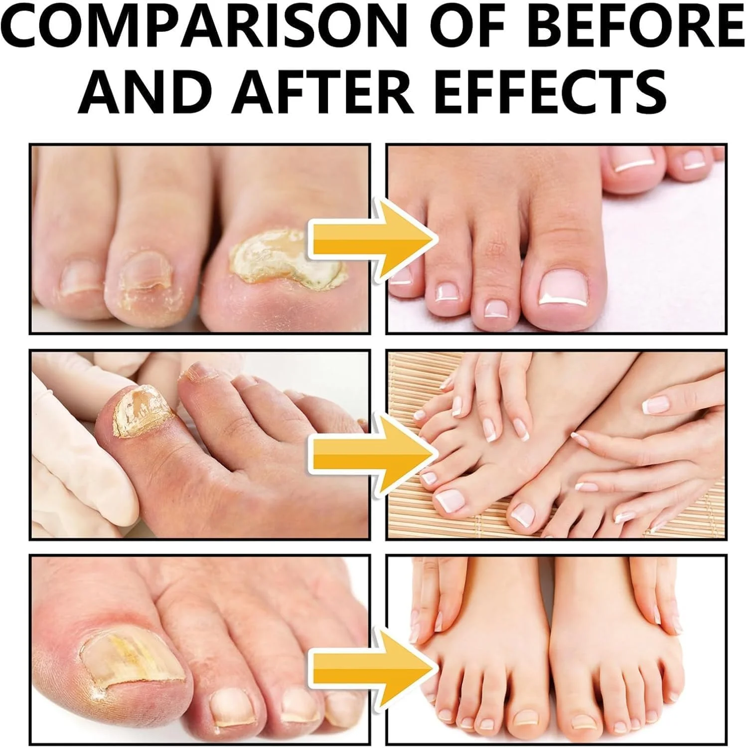 اسپری ضد قارچ پا، درمان پیشرفته پا برای خارش، تعریق، پوسته پوسته شدن و تاول پا، اسپری مایع پا اسپری ضد قارچ پا، درمان پیشرفته پا برای خارش، تعریق، پوسته پوسته شدن و تاول پا، اسپری مایع پا