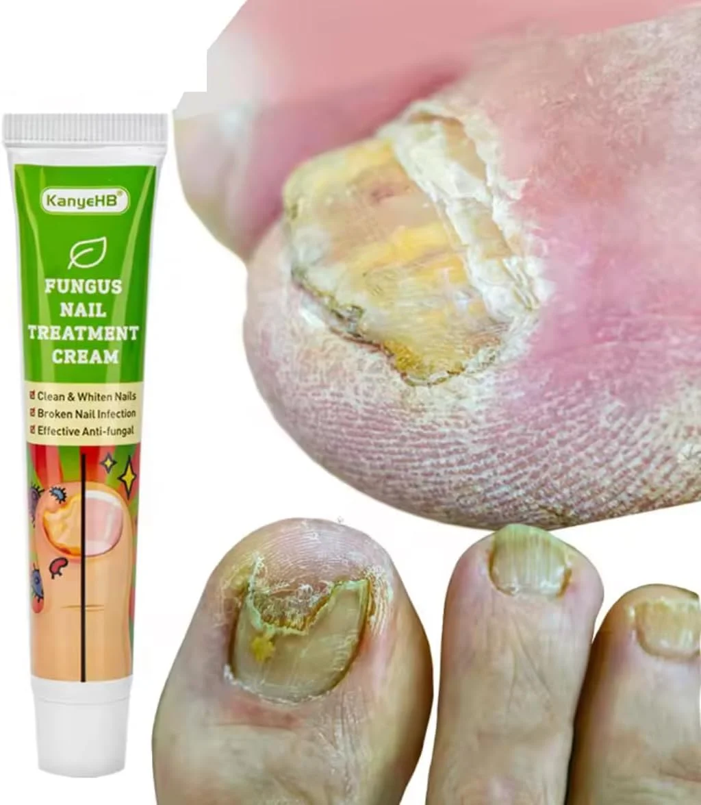 کرم درمان ناخن KanyeHB، محلول ضد قارچ برای عفونت ناخن و سفید کننده