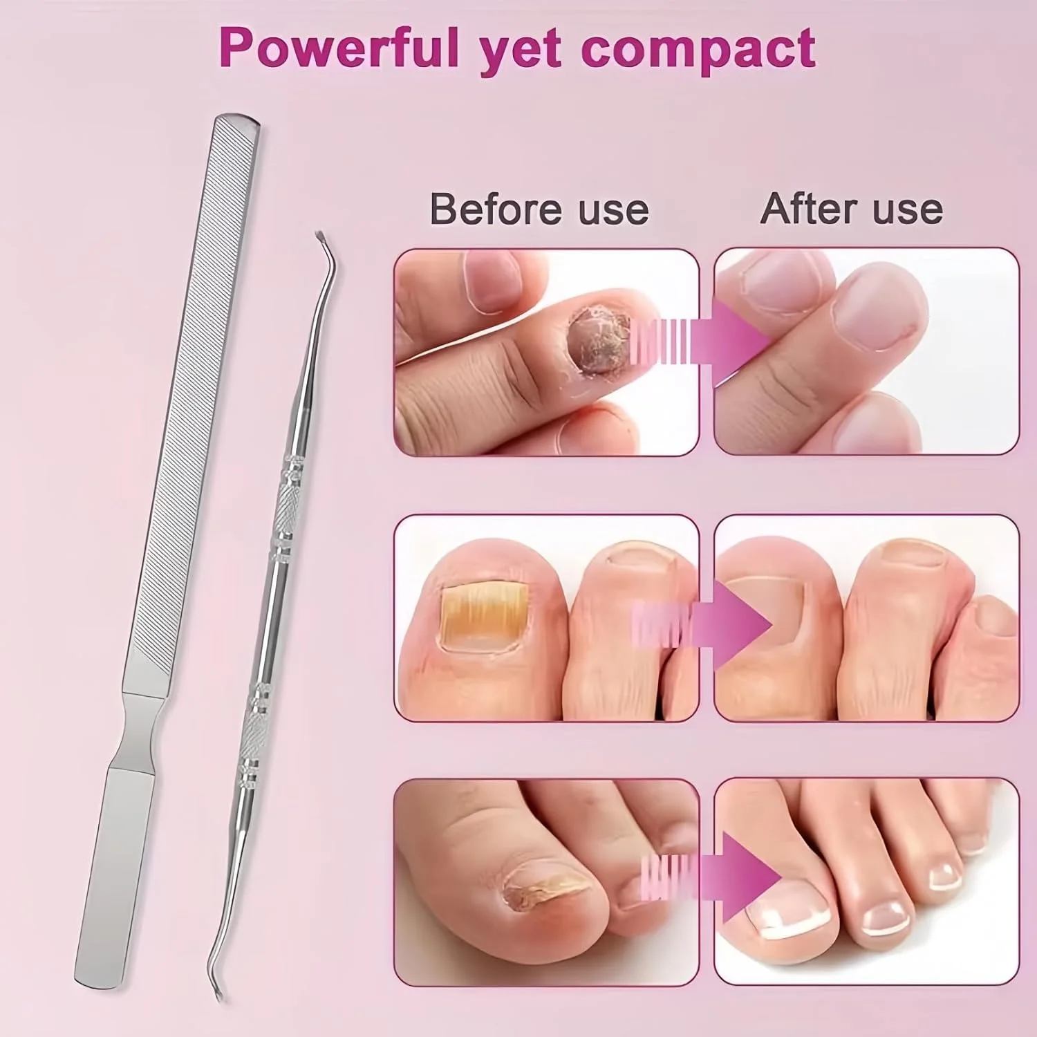 دو ست قاشق تراش + سوهان چهار طرفه، سوهان ناخن بلند استیل برای ناخن های ضخیم و قارچی، ابزار ناخن فرو رفته با بالابر ناخن دو طرفه چند منظوره، سوهان ناخن استیل برای آقایان و بانوان