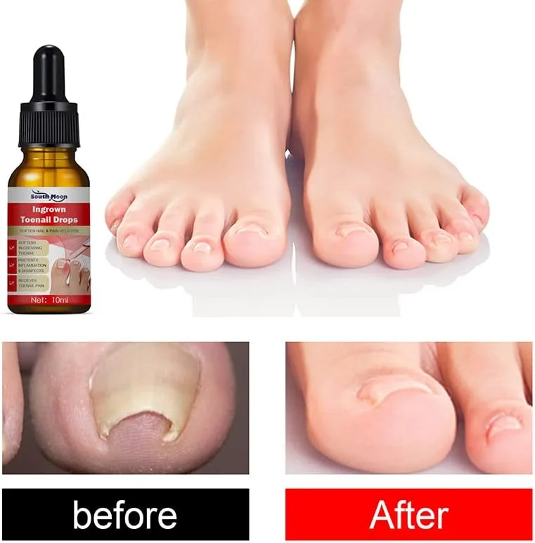 روغن درمان ناخن فرورفته نیل هلپر، قطره ناخن فرورفته، روغن مراقبت از کوتیکول برای ناخن های فرورفته، مراقبت و درمان ناخن، درمان قارچ ناخن (3 عدد، 30 میلی لیتر) روغن درمان ناخن فرورفته نیل هلپر، قطره ناخن فرورفته، روغن مراقبت از کوتیکول برای ناخن های فرورفته، مراقبت و درمان ناخن، درمان قارچ ناخن (3 عدد، 30 میلی لیتر)