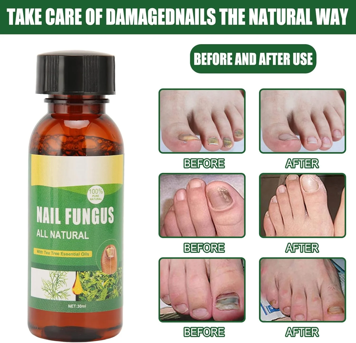 سرم ترمیم ناخن پا 30 میلی لیتری، روغن درخت چای برای ناخن های آسیب دیده، سرم کوتیکول برای ناخن های سفت تر و ضخیم تر