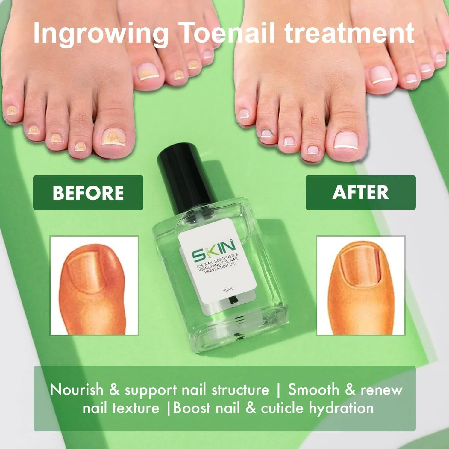 روغن نرم کننده ناخن پا و جلوگیری از فرو رفتن ناخن در گوشت اسکیناپیل 15 میلی لیتر - تغذیه کننده مانیکور و احیا کننده کوتیکول، درمان طبیعی