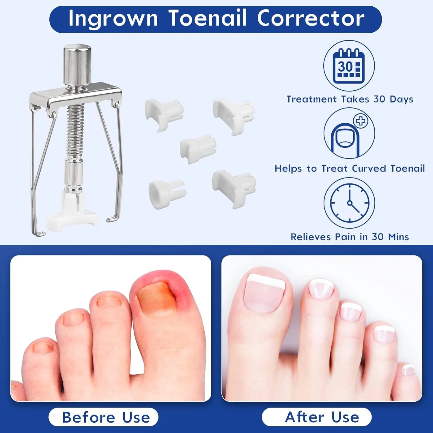 مجموعه رفع ناخن فرورفته تزویق، مجموعه حرفه ای رفع ناخن فرورفته با صاف کننده ناخن فرورفته، مجموعه صاف کننده ناخن پا مجموعه رفع ناخن فرورفته تزویق، مجموعه حرفه ای رفع ناخن فرورفته با صاف کننده ناخن فرورفته، مجموعه صاف کننده ناخن پا