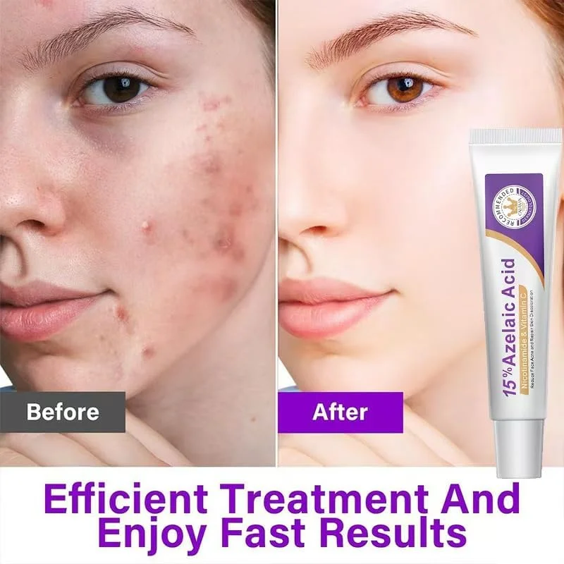 کرم ضد جوش حاوی 15% آزلائیک اسید، سرم آزلائیک اسید، ویتامین C و هیالورونیک اسید و نیاسینامید، درمان صورت برای رفع قرمزی، صاف کننده پوست و لک، پاک کننده منافذ (1 عدد) کرم ضد جوش حاوی 15% آزلائیک اسید، سرم آزلائیک اسید، ویتامین C و هیالورونیک اسید و نیاسینامید، درمان صورت برای رفع قرمزی، صاف کننده پوست و لک، پاک کننده منافذ (1 عدد)