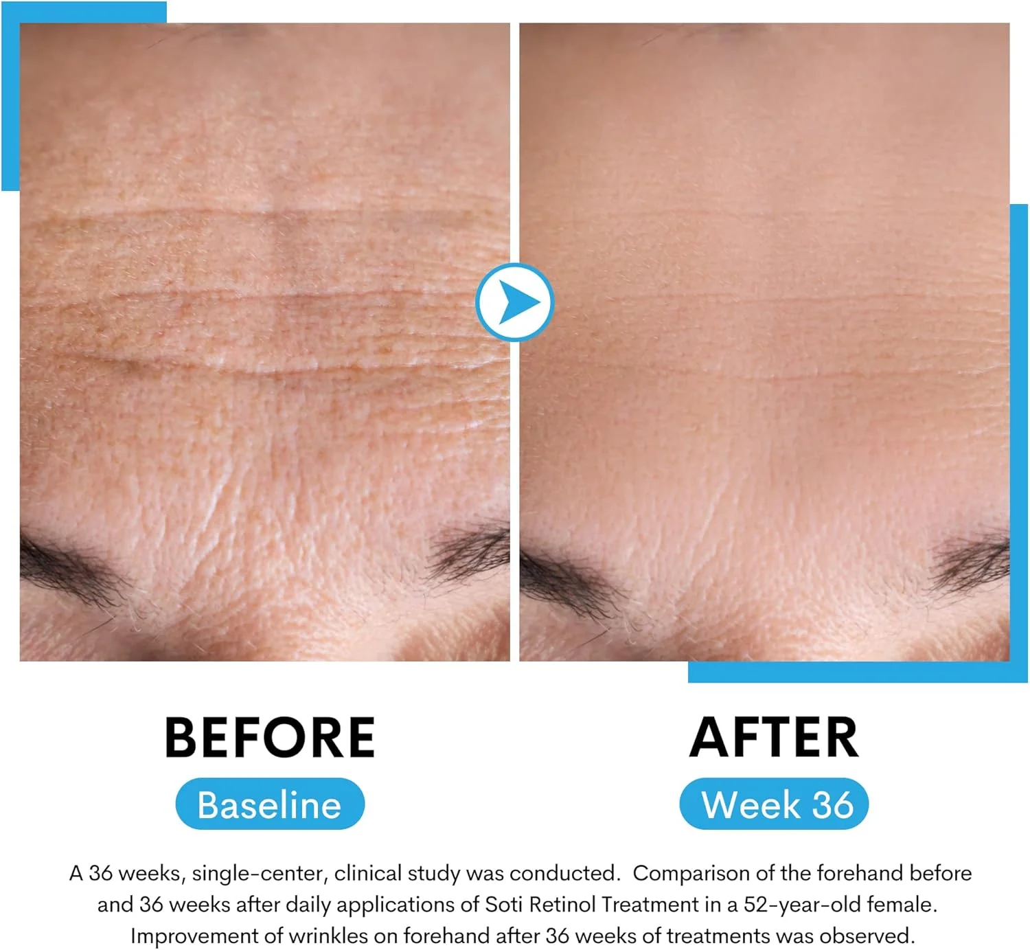 سرم صورت ، کاهش دهنده چین و چروک، لکه‌های ناشی از افزایش سن، جای جوش. تحریک کننده کلاژن، سفت کننده پوست، ضد پیری با اسید هیالورونیک، نیاسینامید (30 میلی لیتر) سوتی