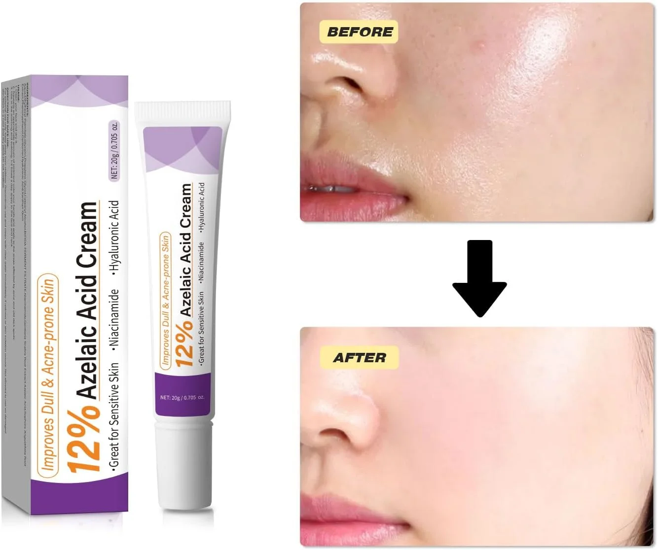 کرم 12% آزلائیک اسید - سرم صورت برای کاهش لکههای تیره، قرمزی، پوست چرب و مستعد جوش - حاوی نیاسینامید و هیالورونیک اسید، 20 گرم کرم 12% آزلائیک اسید - سرم صورت برای کاهش لکههای تیره، قرمزی، پوست چرب و مستعد جوش - حاوی نیاسینامید و هیالورونیک اسید، 20 گرم