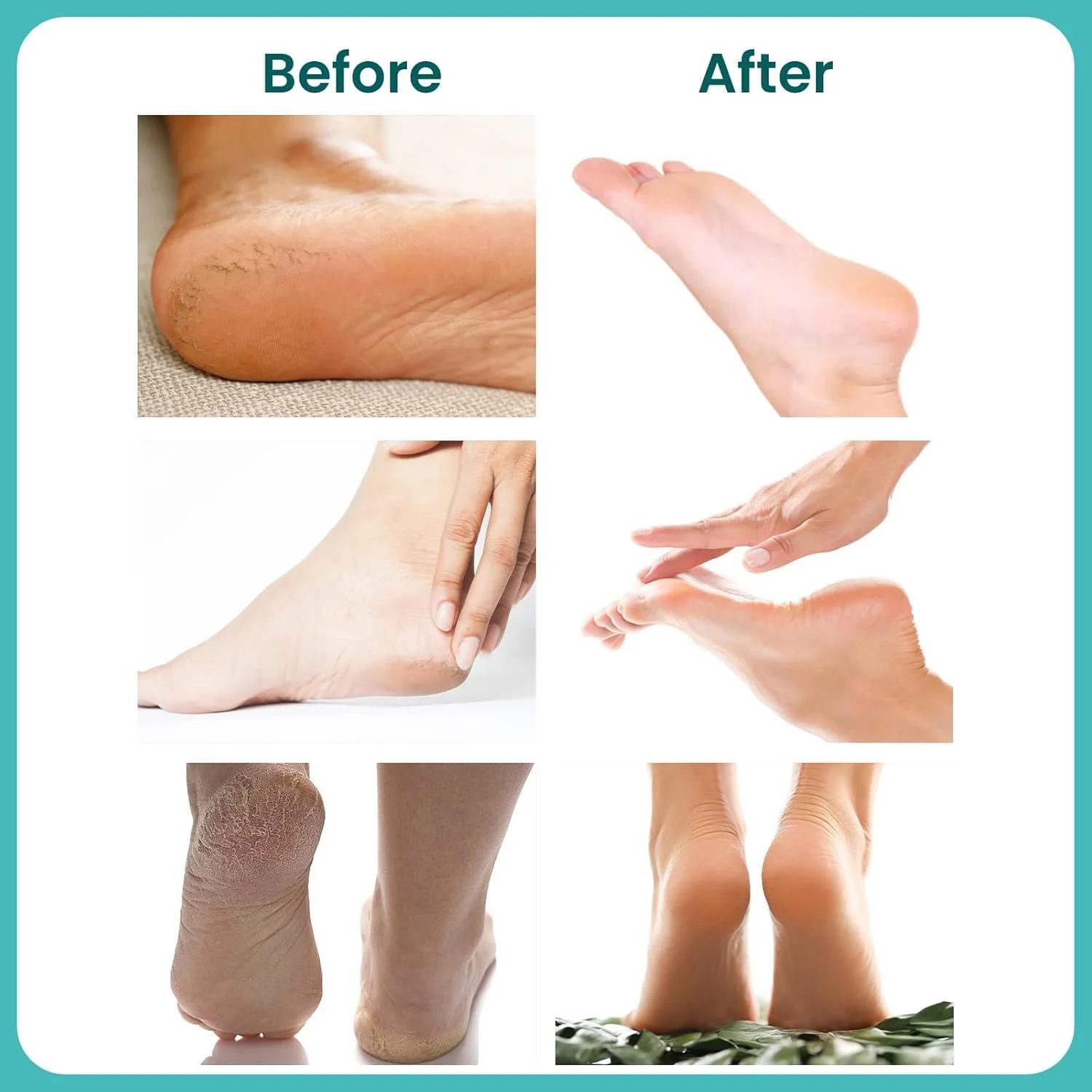 کرم اوره ۴۰ درصد نالاکال برای پا، قدرت حداکثری ۱۵۹ گرم، کرم پا برای پاشنه و پای خشک و ترک خورده، مرطوب کننده عمیق و از بین برنده پینه