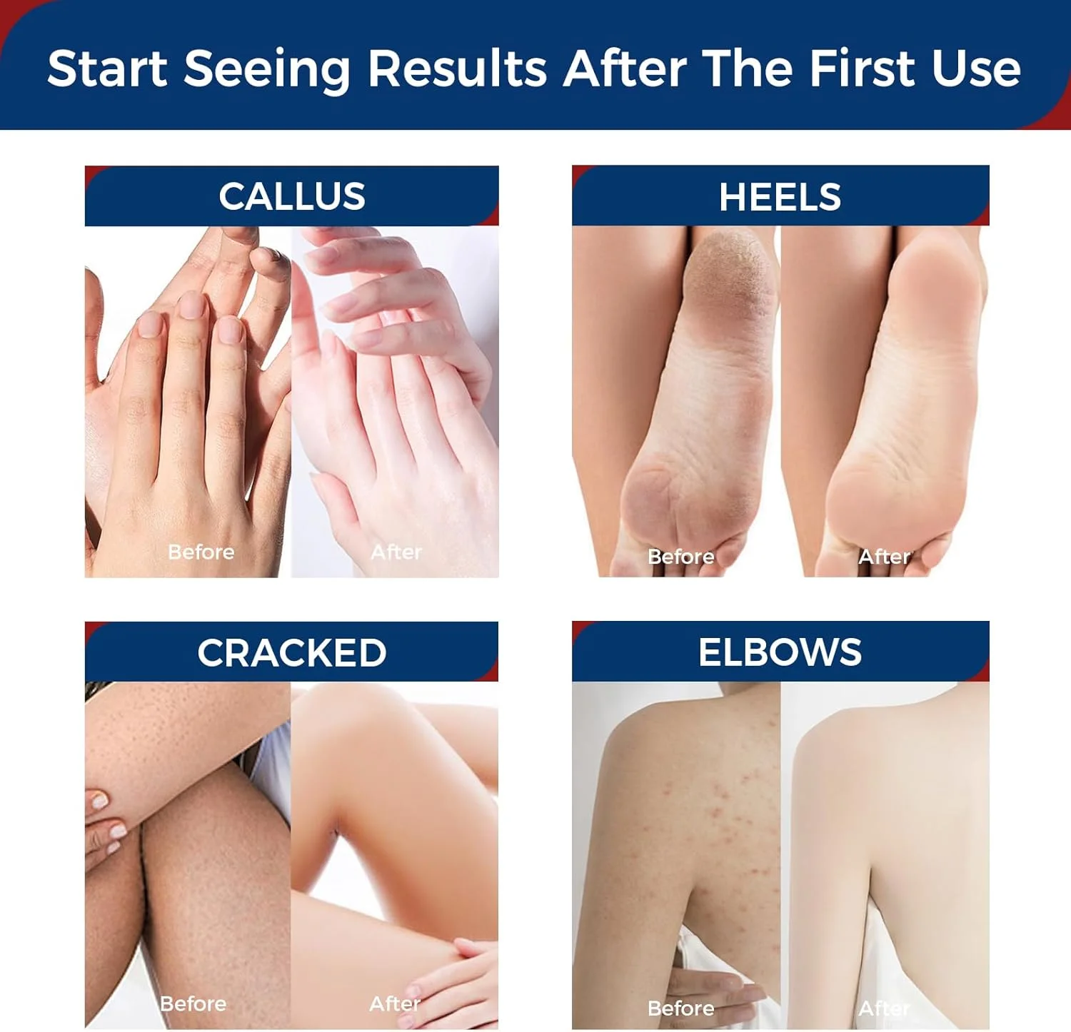 کرم پای اوره اوکیا ۴۲ درصد با ۲ درصد سالیسیلیک اسید، مرطوب کننده عمیق برای پوست خشک و ترک خورده، لوسیون اوره نرم کننده پینه ها و پاشنه های ضخیم، مراقبت از پا برای پوست بسیار خشک ۸۵ گرم