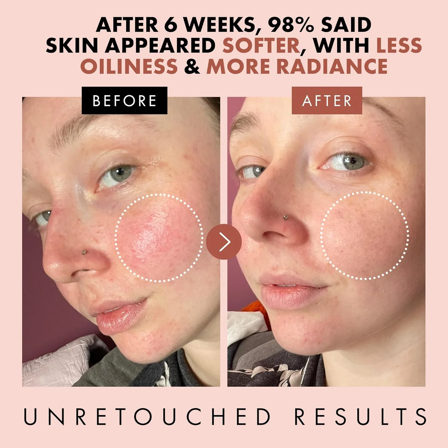 تونر گلاب اکلات اسکین‌کر - گلاب خالص با اسید هیالورونیک و آلوئه ورا، تونر صورت کوچک کننده منافذ، تونر آبرسان صورت برای زنان، تونر جوان کننده و تسکین دهنده پوست