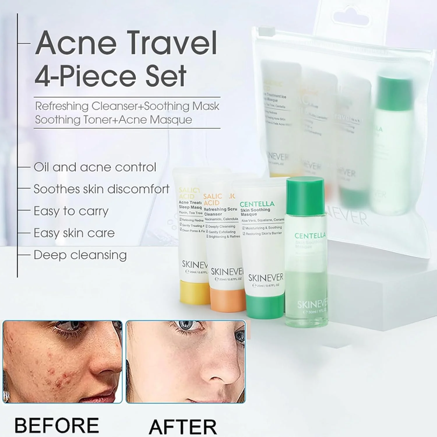 مجموعه مراقبت از پوست نالاکال برای ضد لک، کیت روتین مراقبت از پوست آکنه سایز مسافرتی، مجموعه ها و کیت های مراقبت از پوست، پاک کننده، مشک، تونر، ماسک آکنه، کیت صورت کنترل چربی و حذف آکنه، برای پوست مستعد آکنه