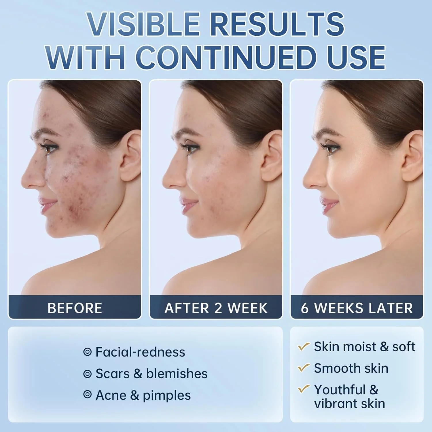 کرم ۱۴% آزلائیک اسید، درمان آکنه، تسکین قرمزی، لکه‌های تیره، نیاسینامید، ویتامین C، سرم صورت، تعادل سبوم، پوست حساس