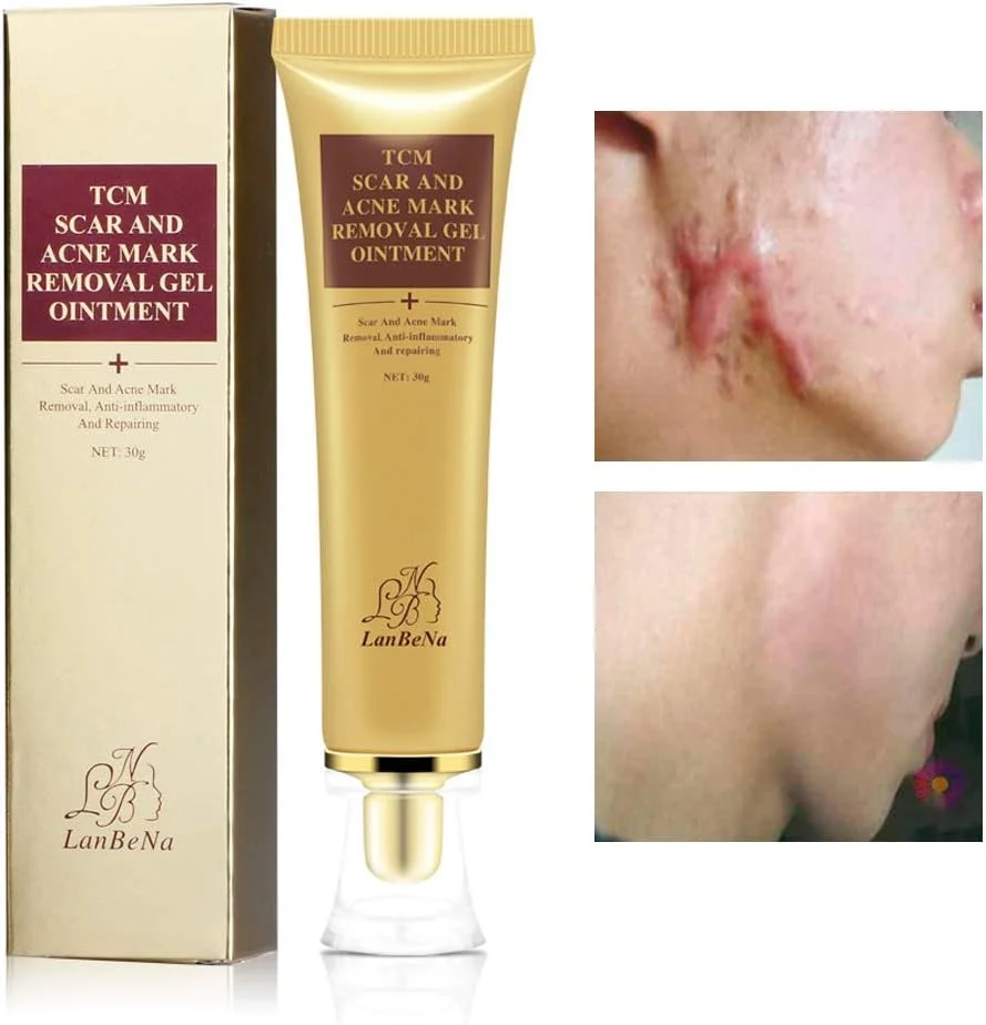 کرم رفع جای جوش LANBENA، درمان جوش های سرسیاه و از بین برنده جای زخم صورت
