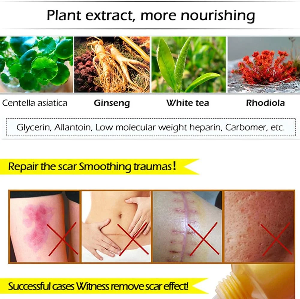 کرم رفع جای جوش LANBENA، درمان جوش های سرسیاه و از بین برنده جای زخم صورت