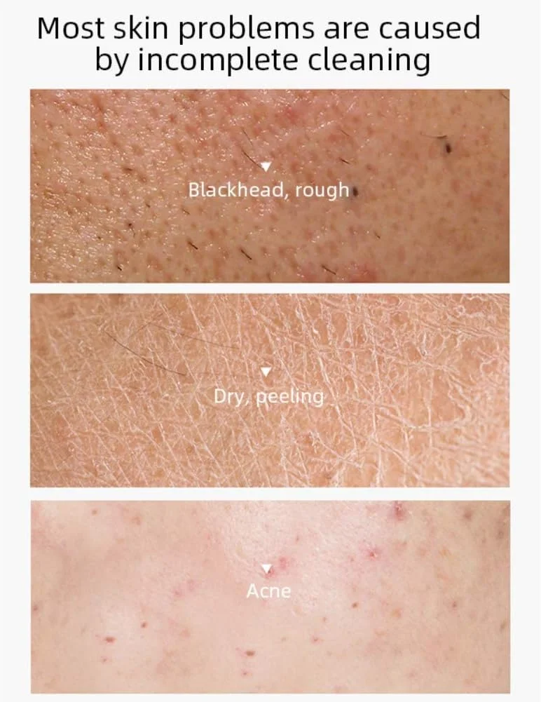 پاک کننده صورت، پاک کننده جوش و آکنه، کرم شستشوی صورت، کنترل چربی، ضد جوش های سرسیاه، کوچک کننده منافذ، پاک کننده منافذ برای انواع پوست معمولی، چرب، خشک و حساس، مناسب برای آقایان و بانوان - 1 عدد