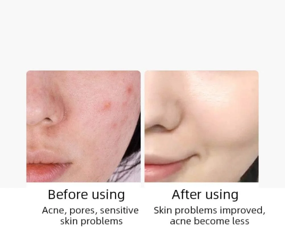 پاک کننده صورت، پاک کننده جوش و آکنه، کرم شستشوی صورت، کنترل چربی، ضد جوش های سرسیاه، کوچک کننده منافذ، پاک کننده منافذ برای انواع پوست معمولی، چرب، خشک و حساس، مناسب برای آقایان و بانوان - 1 عدد