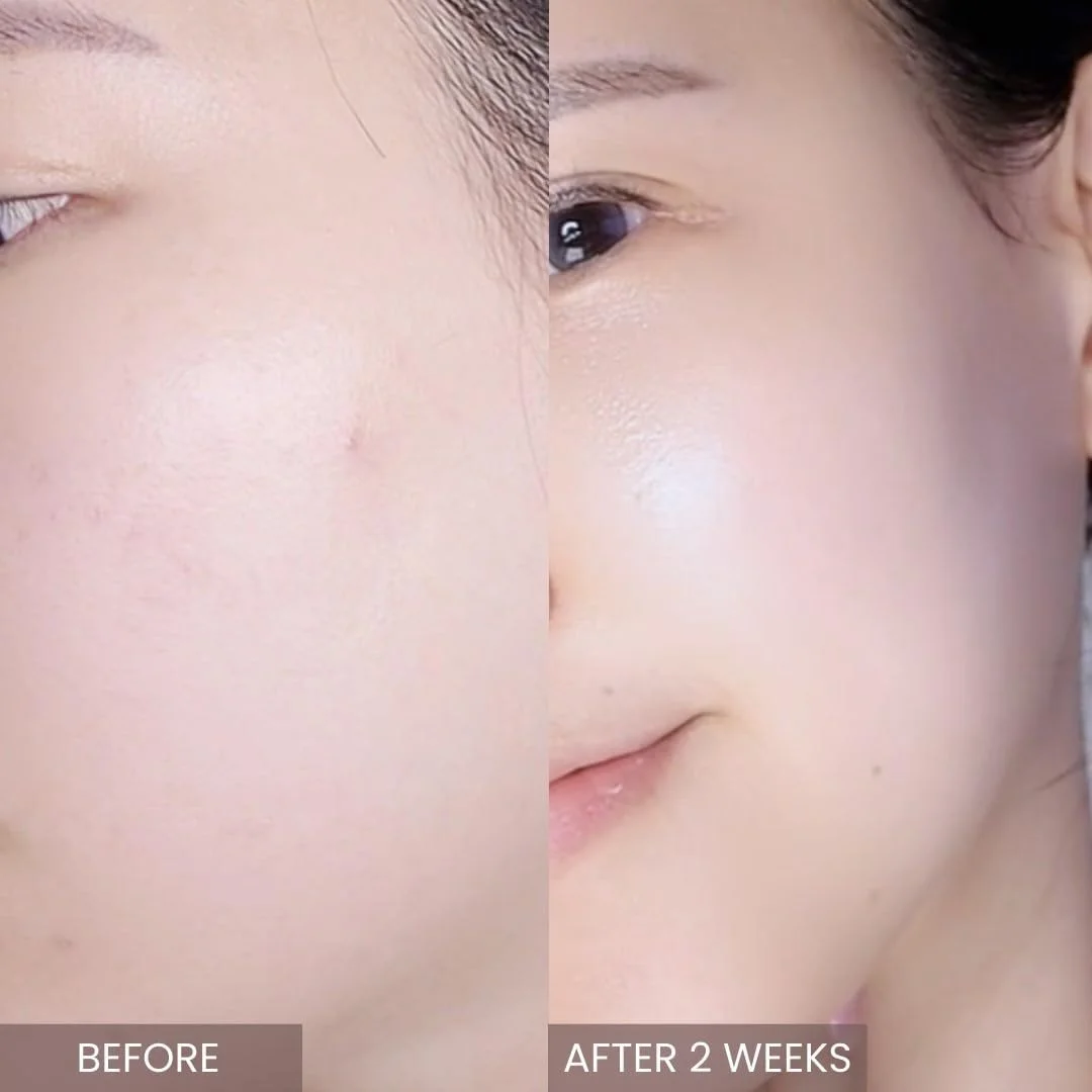 کرم فشرده درخت چای صورتی آپلین - 50 گرم/مرطوب کننده پوست/مرطوب کننده های صورت/1.7 اونس، سیکا، آلانتوئین، مراقبت از پوست کره ای، مرطوب کننده، آبرسان