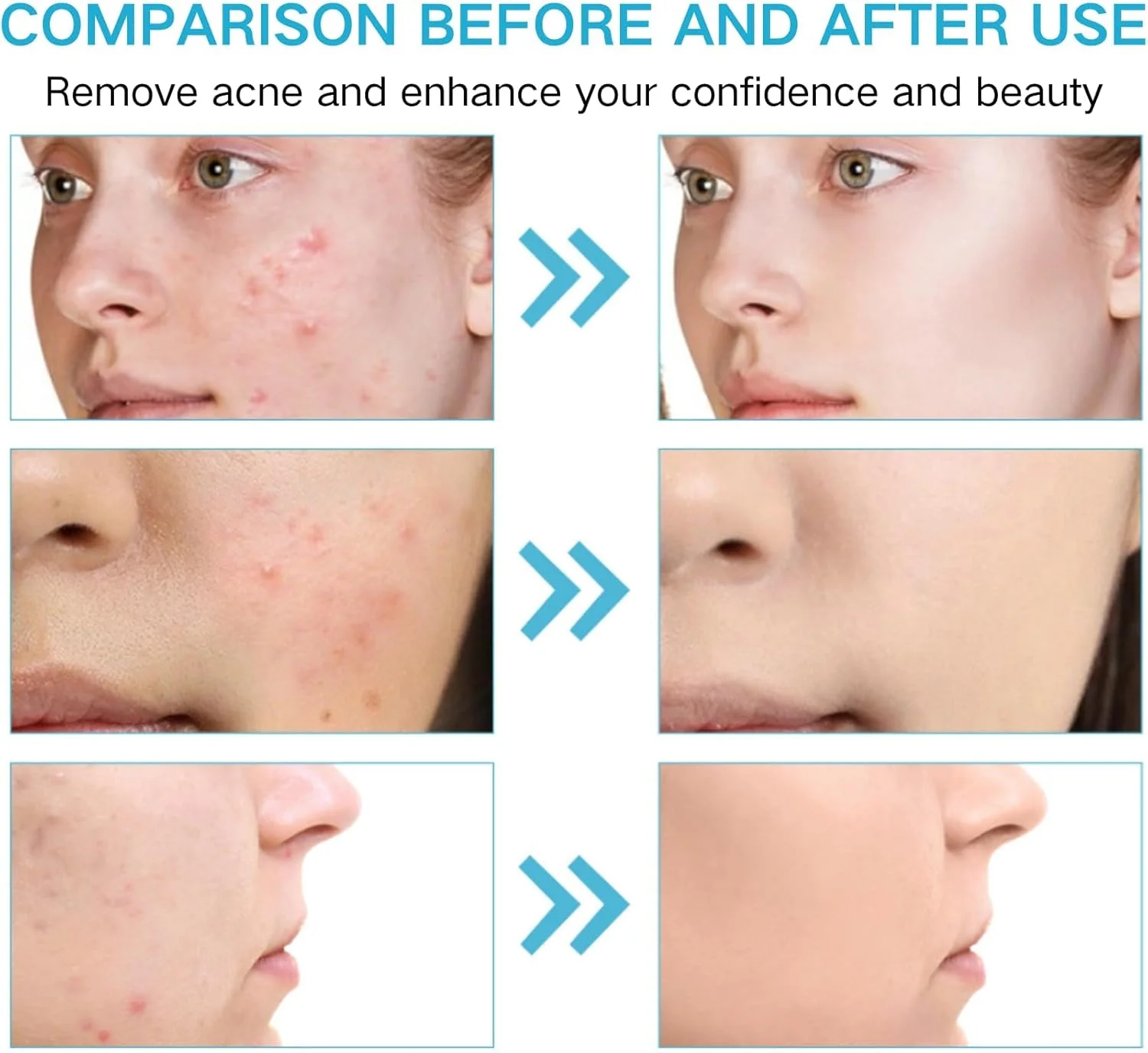 کرم اسید سالیسیلیک برای پوست مستعد جوش، ژل درمان جوش، از بین برنده لک های تیره صورت، مناسب برای جوش های فعال، متعادل کننده چربی، سفت کننده منافذ، محو کننده جای جوش، کنترل و رفع آکنه کرم اسید سالیسیلیک برای پوست مستعد جوش، ژل درمان جوش، از بین برنده لک های تیره صورت، مناسب برای جوش های فعال، متعادل کننده چربی، سفت کننده منافذ، محو کننده جای جوش، کنترل و رفع آکنه