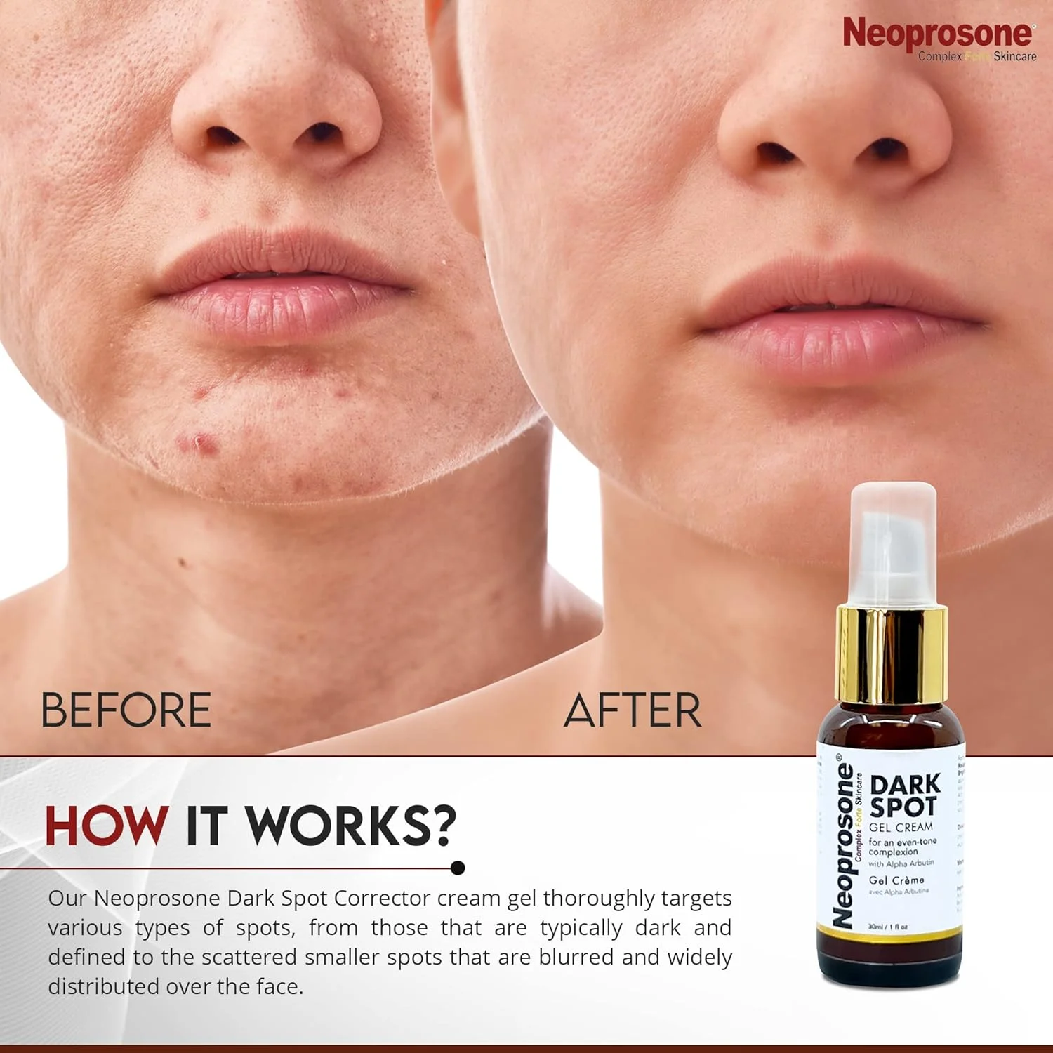 ژل کرم از بین برنده لکههای تیره نئوپروزون - 30 میلی لیتر - ژل کرم صورت، کاهش آکنه، لکههای ناشی از آفتاب، لکههای پیری روی صورت، زانوها، آرنجها، دستها، نواحی خصوصی ژل کرم از بین برنده لکههای تیره نئوپروزون - 30 میلی لیتر - ژل کرم صورت، کاهش آکنه، لکههای ناشی از آفتاب، لکههای پیری روی صورت، زانوها، آرنجها، دستها، نواحی خصوصی