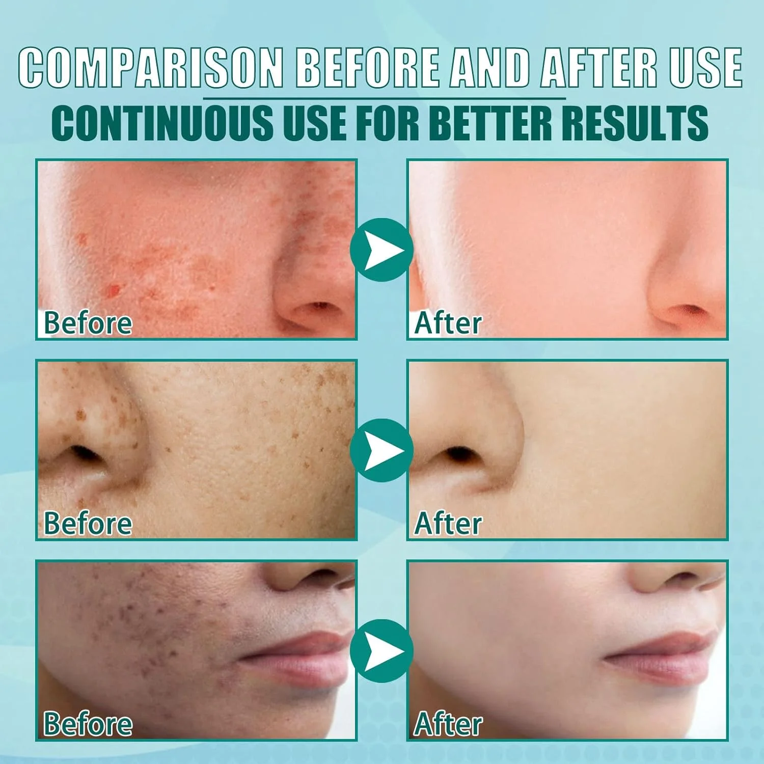 کرم گیاهی روشن کننده و از بین برنده لک – اصلاح کننده طبیعی لکه های تیره، درمان موثر روشن کننده و ضد لک برای آقایان و بانوان، کاهش دهنده لکه های تیره و کک و مک